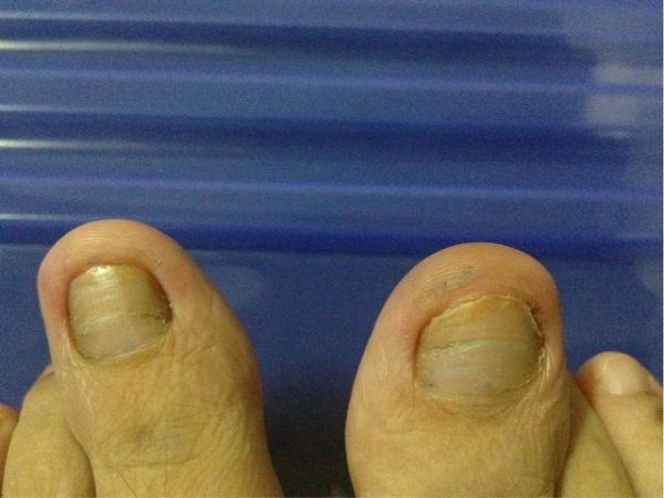 配资台官网最新信息 26岁女性常年穿着袜子睡觉，脚趾甲变成了“千层糕”？这是为什么